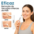 Caneta Laser SkinMedi – Remove Manchas e Verrugas sem Dor - DeusJoy.com