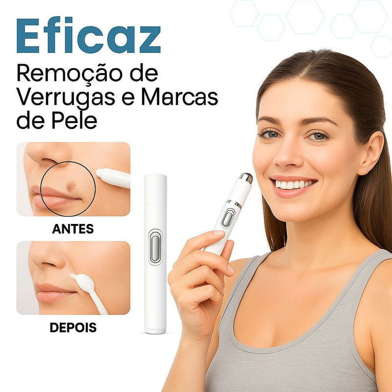 Caneta Laser SkinMedi – Remove Manchas e Verrugas sem Dor - DeusJoy.com