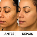 Caneta Laser SkinMedi – Remove Manchas e Verrugas sem Dor - DeusJoy.com
