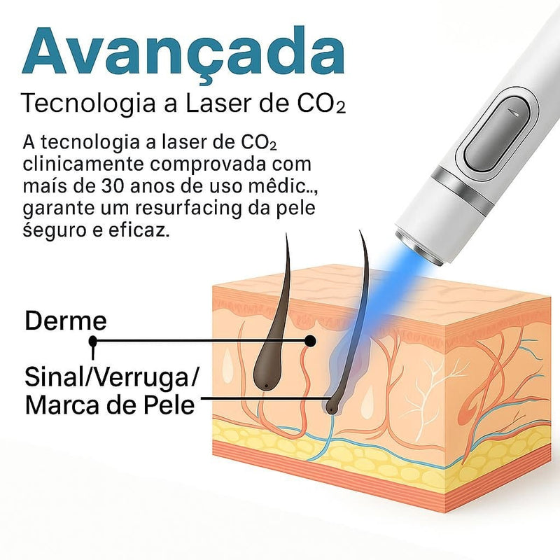 Caneta Laser SkinMedi – Remove Manchas e Verrugas sem Dor - DeusJoy.com