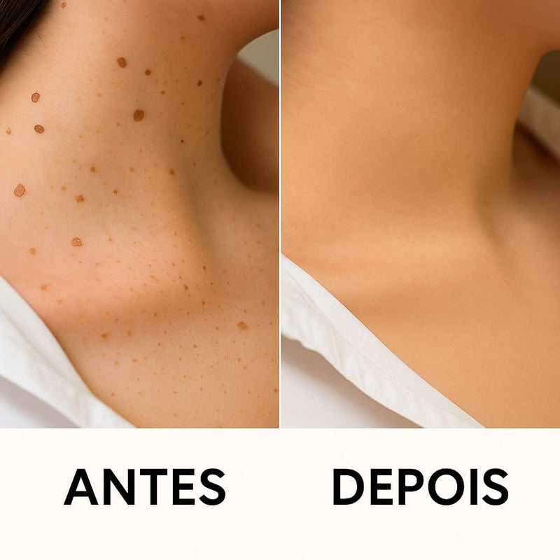 Caneta Laser SkinMedi – Remove Manchas e Verrugas sem Dor - DeusJoy.com